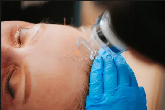 Laser Scar Reduction